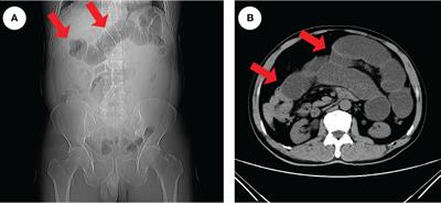 Case Report: Intramural colonic signet ring cell carcinoma presenting as intestinal pseudo-obstruction: A case presentation and review of the literature